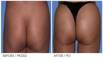 Butt Implant 2