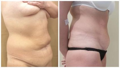abdominoplastyka4