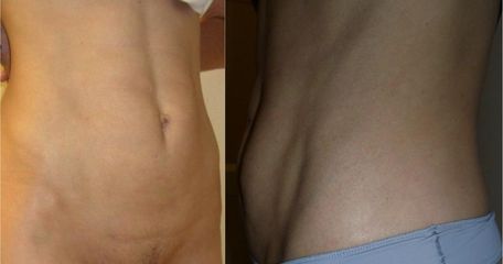 cool lipo2