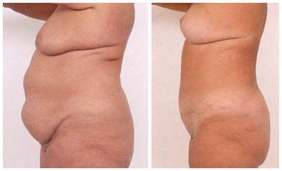 abdominoplastyka5