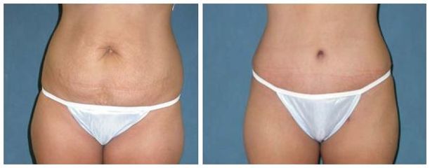 abdominoplastyka6