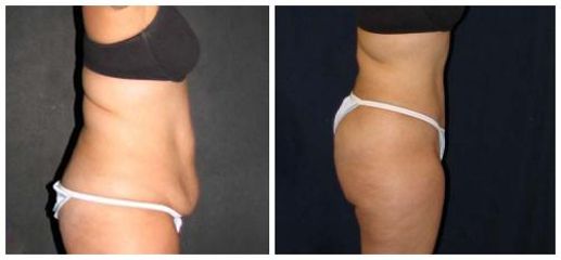 abdominoplastyka8