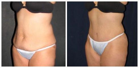 abdominoplastyka9