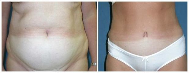 abdominoplastyka7