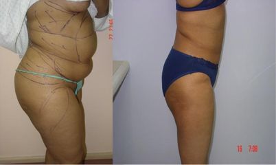 liposukce2