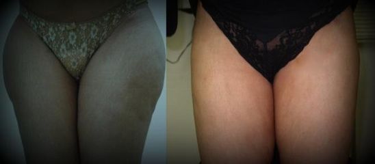 liposukce4
