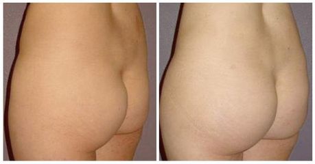 posladki implant2