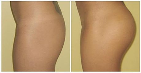 posladki implant3