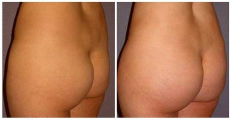 posladki fat graft1