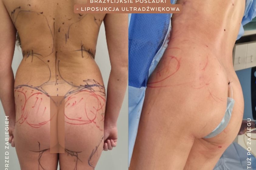Powiększanie pośladków przed i po - 861134