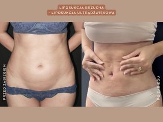 Liposukcja ultradźwiękowa - Mandala Beauty Clinic