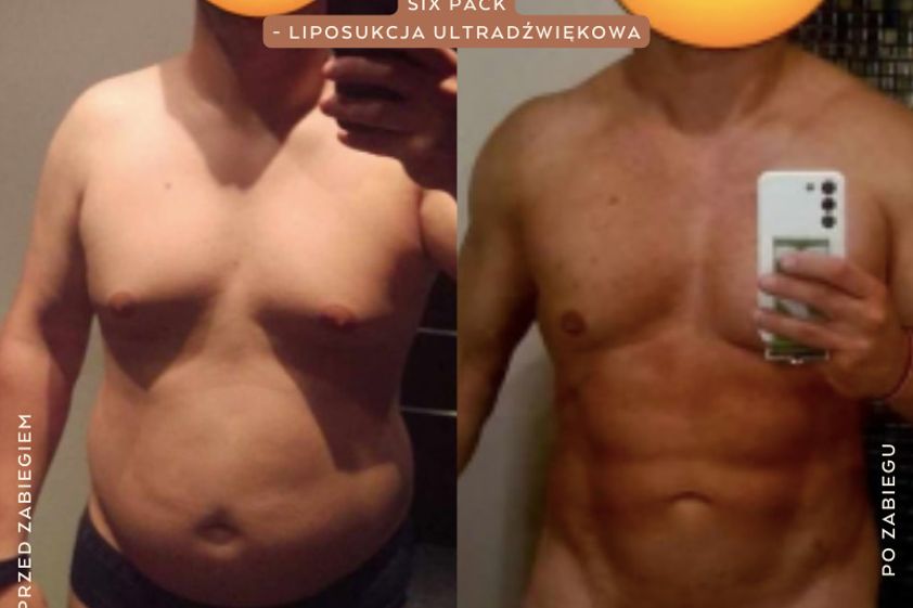 Liposukcja ultradźwiękowa przed i po - 861136