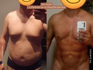 Liposukcja ultradźwiękowa - Mandala Beauty Clinic