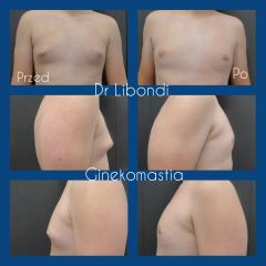 Ginekomastia - lek. med. Guido Libondi