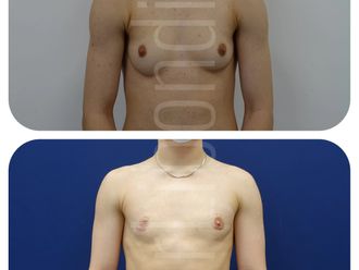 Korekta płci przed i po - 835843