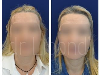 Lipofilling przed i po - 880381