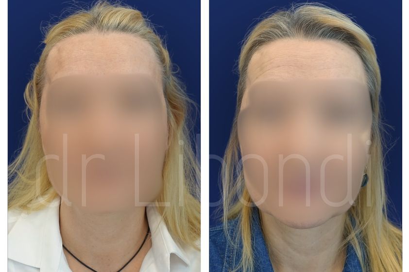 Lipofilling przed i po - 880381