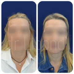 Wypełnienie okolicy skroniowej, Lipofilling - Operator: dr Guido Libondi