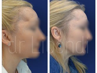 Lipofilling przed i po - 880382