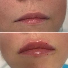 Powiększanie ust - Dr Iwona Anna Gołębiowska