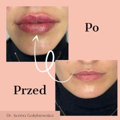 powiększanie ust kwasem hialuronowym - Dr Iwona Anna Gołębiowska