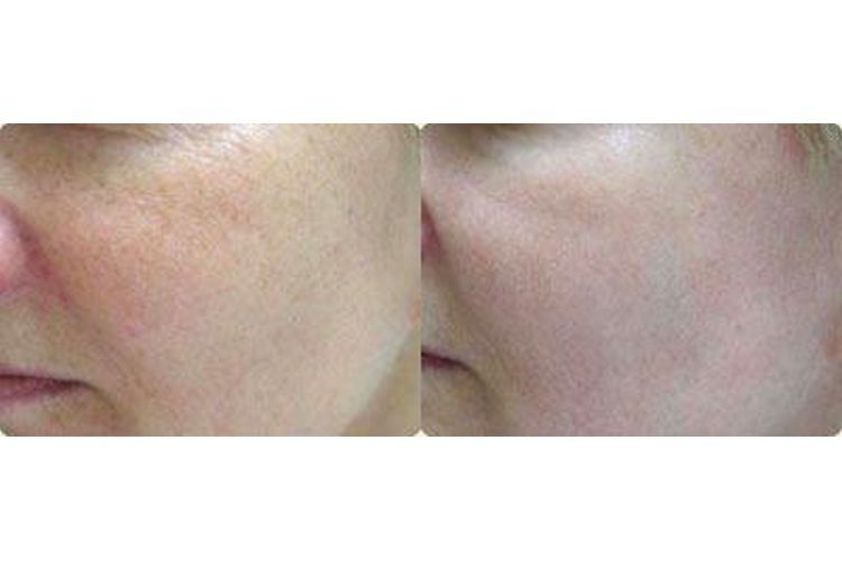 IPL przed i po - 688399