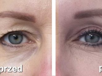 Blefaroplastyka przed i po - 870212