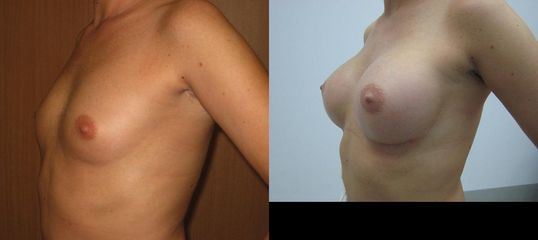 Powiększanie piersi - przed i po
