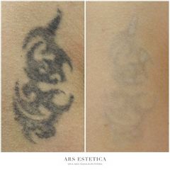 Usuwanie tatuażu - Ars Estetica