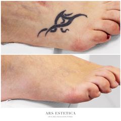 Usuwanie tatuażu - Ars Estetica