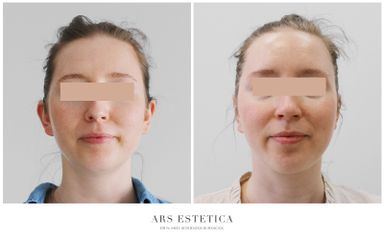 Korekcja uszu - Ars Estetica