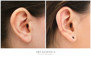 Korekcja uszu - Ars Estetica