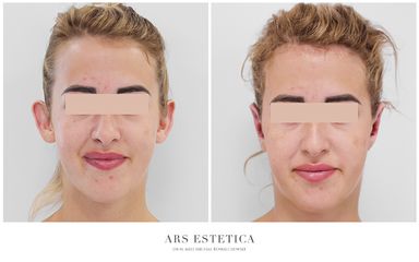 Korekcja uszu - Ars Estetica