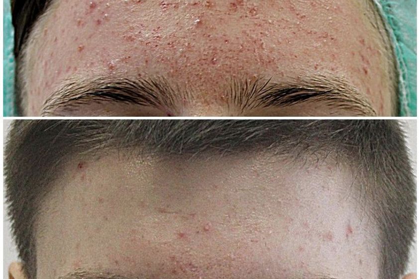 Peeling chemiczny przed i po - 850851