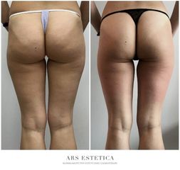 Termolifting - Ars Estetica