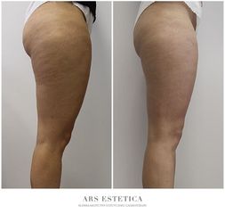 Termolifting - Ars Estetica