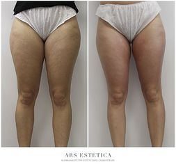 Termolifting - Ars Estetica