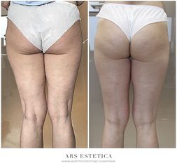 Termolifting - Ars Estetica