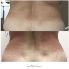 Termolifting - Ars Estetica