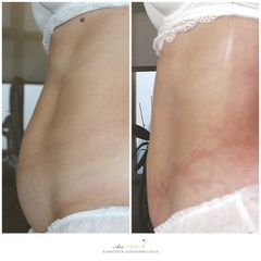 Termolifting - Ars Estetica