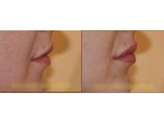 Powiększanie ust - przed i po