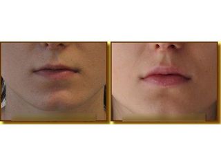Powiększanie ust - przed i po