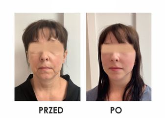 Lifting twarzy - dr Agnieszka Krupińska MediArt Clinic