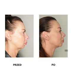 Lifting twarzy - dr Agnieszka Krupińska MediArt Clinic