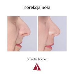 Korekta nosa - Dr Zofia Bochen