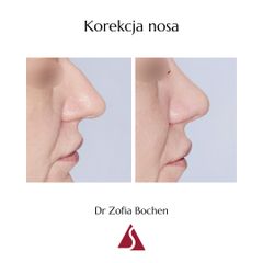 Korekta nosa - Dr Zofia Bochen