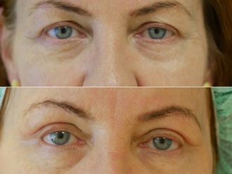 Blefaroplastyka przed i po - 869840