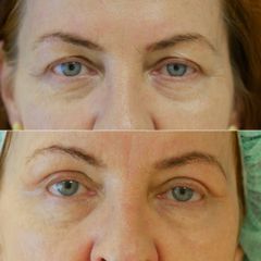 Blefaroplastyka - dr n. med. Marta Raczkowska-Muraszko