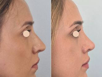 Korekta nosa przed i po - 877718