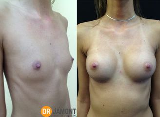 piersi_1